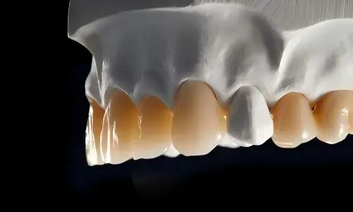 Multi-Layer Zirconia Crowns: Benefits, Applications and Material Features